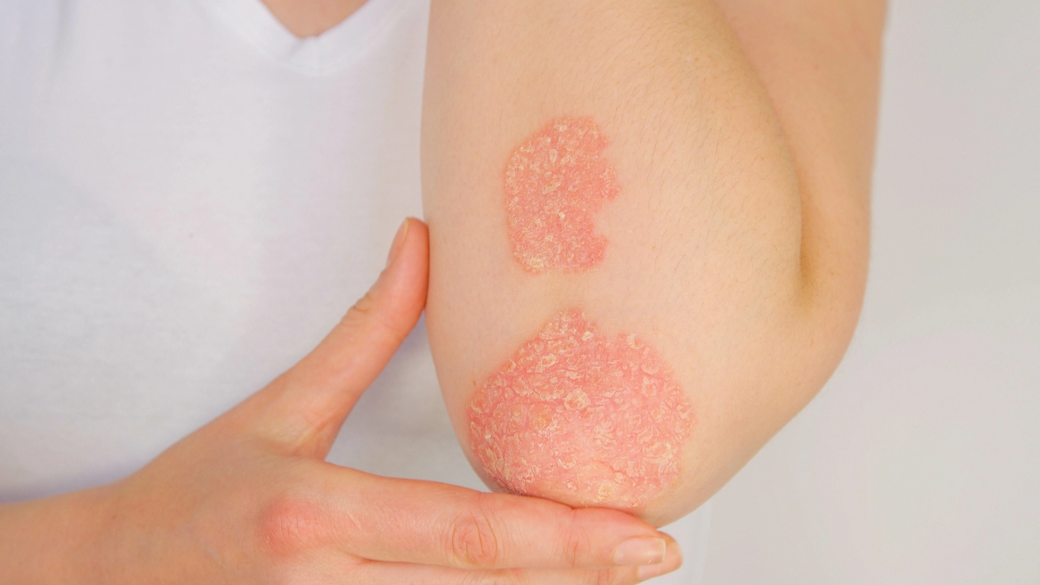 Hey Body - Rotlicht Anwendung/Therapie - Frau mit großem roten, schuppigen Ausschlag, die an Psoriasis-Arthritis im Ellenbogenbereich leidet